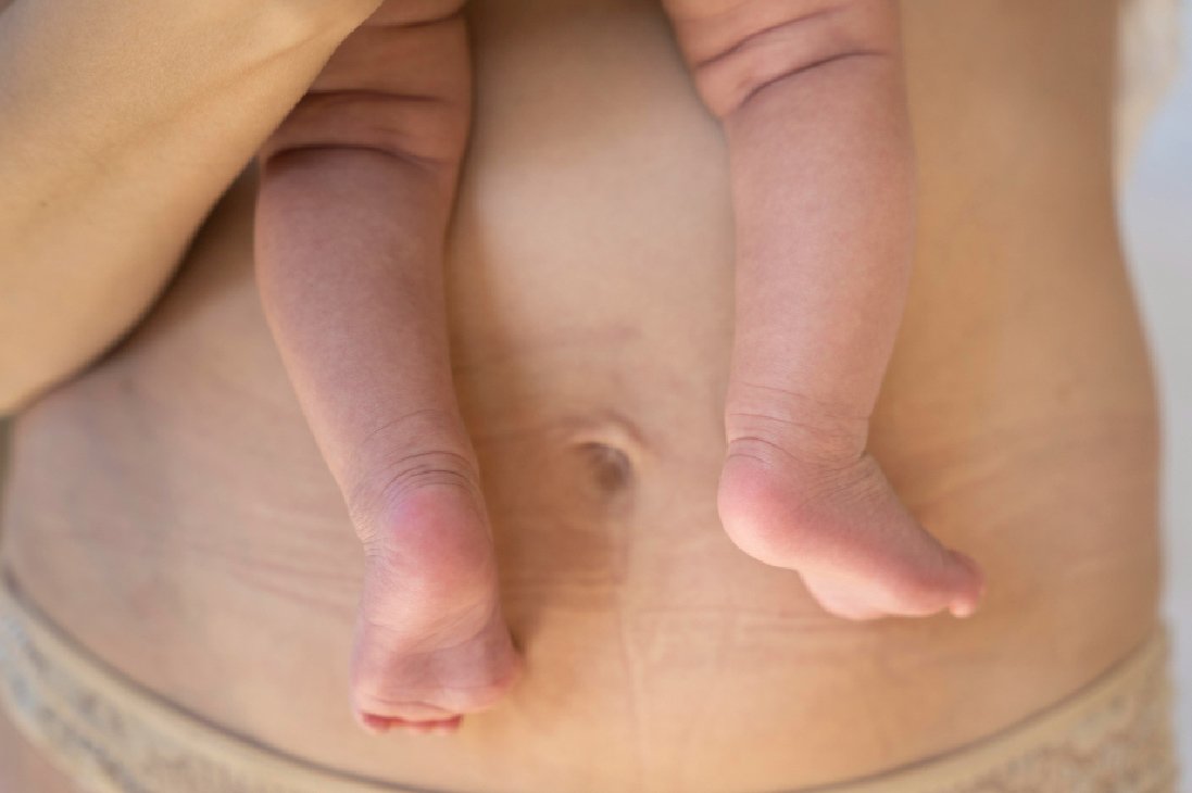 Stretch Marks Treatment In Bangalore